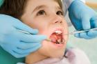 شیوع بالای پوسیدگی دندان در کودکان ایرانی/زنگ خطر برای دوران بزرگسالی